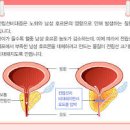 전립선비대증 증상 약 치료 커피 줄이기 이미지