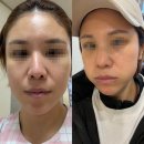 김천미성형외과의원 | 범계 닥터로미 성형외과 코수술 한달 후기, 코 수술 한달차 증상 총 정리