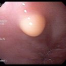 papilloma of the esophagus 이미지