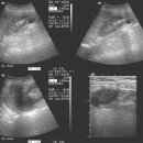 both renal cyst 이미지