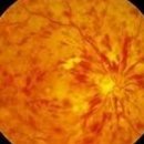 망막정맥폐쇄 (Retinal Vein Occlusion) 이미지