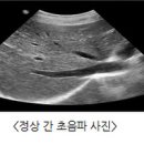 담낭염 증상 및 원인과 제거 수술 급성 만성 이미지