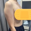 멍이가 웃통벗는날 | 서울 팔 지방흡입:: 예신 다이어트 후기 1탄(병원선택/수술당일/붓기/통증/회복)