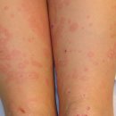 경화반점 이미지