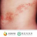 대상포진 초기증상부터 전조 증상까지, 원인 전염성 병원 선택 정리 이미지