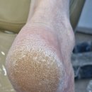 케어메디칼 | 메디컬풋케어 방문기청주발관리 후기가 궁금하다면