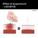 척척마디한의원 네이버블로그