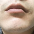 송준호레이메디의원 | [송준호 레이메디의원] 수염 레이저 제모 1회차(수혐주의)추가