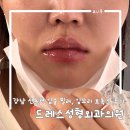 영신버스 | 강남 드레스 성형외과 입술필러 3cc 내돈내산 후기+입꼬리 보톡스 (독일 수입 아말리안)