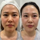 오케이글로벌메디컬 | 관리 콜드플라즈마지사 아미뷰티 아카데미에서 풀페이스 AI플라즈마받고 팔자바뀐 열혈팬의 내돈내산 후기