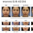 브이라인