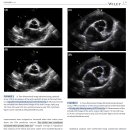 Systemic hypertension이 있는 개와 정상 개에서 aortic cusps의 size 및 shape의 차이 이미지