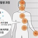 자가면역질환[Autoimmune disease] 이미지