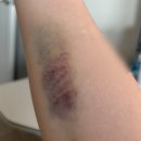 나은병원 | 20대 여자 하복부 아랫배 통증 난소 물혹 제거 수술 나은병원 입원 후기