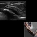 3D How To: Ultrasound Guided Median and Ulnar Nerve Block - SonoSite Ultrasound 이미지