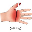 수부 외상 (Hand Trauma) 이미지