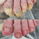 부모님발톱,, 안녕하시렵니까? (마곡발톱무좀 전문)