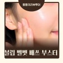 경희지성한의원 | 이마 여드름 원인 고민이라면, 블립 벨벳 배쓰 부스터 한방앰플 사용 후기