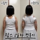 365MC의원 | 일산 팔뚝 무한람스 뒷볼록 광배살 멍 붓기 통증 가격 보틀 수 당일 생생 후기 365MC의원 일산점