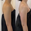 어울림빌 | 운동으로 안빠지는 팔뚝살, 서산에스테틱 팔뚝·부종·슬리밍 고민 한번에 해결한 에어바디 솔직후기