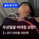 수 한의원 | 안면비대칭 고칠 수 있을까? + 온다 리프팅 후기 | 강남 한의원