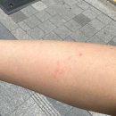 (사진주의) 임신 34주 대상포진 후기, 대학병원 다니길 잘했다고 생각한 날