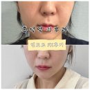 오롯의원 | 흑석역 피부과 추천 인모드FX+윤곽주사 효과, 통증, 다운타임 솔직후기!