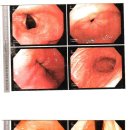 중등도의 만성위염 및 위궤양, 역류성 식도염 (내시경 사진 첨부) 이미지