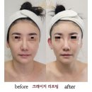 바르델 | 구미 피부관리 형곡 바르델 고주파리프팅 1회 후기