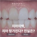 치아미백이 치아를 손상시킨다는 말, 사실일까요?