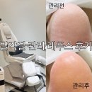종로 광화문 발각질 레푸스 첫방문 후기 양서윤 푸스플레게 이벤트