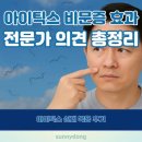 의견 | 아이틱스 비문증 효과? 후기와 전문가 의견 총정리