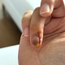 예손병원 | 예손병원 사구체종양 수술 후기 3탄 (6개월 경과)