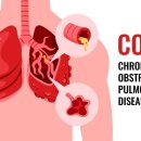 만성폐쇄성폐질환(COPD) 줄기세포치료 이미지