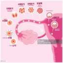 연이산부인과의원 | 일산 마리아 병원 나팔관 조영술 통증 후기 가격 결과 정자검사
