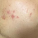 대학약국 | 약국 재생크림 피부과 레이저 시술후 이지에프 다 써본 후기