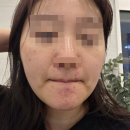 서울필치과의원 | 서울 홍대 제이필의원 아그네스 후기(6개월 후 리뷰, 여드름시술 추천)