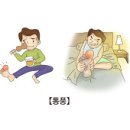 의학과한방(동영상):통풍 (Gout) 이미지