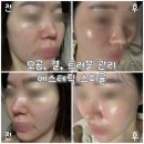 안산고잔바로튼튼의원 | 피부과 리쥬란, 레이저, 포텐자 후 장벽무너짐으로 에스테틱에서 스피큘한 내돈내산 후기