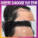 [30대 남자 M자탈모 높은이마 머리심기] 비절개 히든컷 모발이식 2400모 1년 후기 (모엠의원/M자탈모/전지훈원장) 이미지