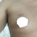 (주)영대 | 유방암치료일지_영대병원 유방암 방사선 치료 20회 후기