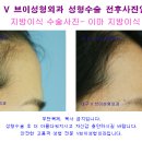 꺼진 이마 지방이식 비용은? 도톰한 예쁜 이마 만들기, 대구성형외과 잘하는곳 이미지