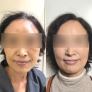피부과 튠페이스 내돈내산 60대 리프팅 타임락튠 1차 일주일 후기 (비포에프터 사진O)