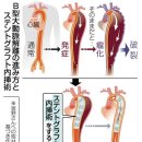 스텐트그라프트치료 인공혈관을 삽입 환부를 보강 대동맥해리의 예후개선도 이미지
