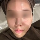 강남 신논현역 온다리프팅 레이저 효과 후기