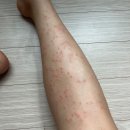 폴메디케어 | 웨딩촬영 직전 모공각화증 없앴던 방법 공개합니다!! (두달 치료 후기)