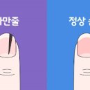 손톱 검은 세로줄 원인 예방 내 몸이 보내는 적신호일까? 이미지