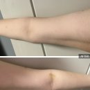 예술회관역 | 인천 예술회관역 내돈내산 지방분해주사 후기 2회차