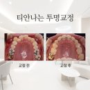수석치과의원 | 청량리역 교정치과 티 안나는 덧니 얼굴비대칭 투명교정 방법