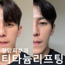 강남 티타늄리프팅 잘하는곳 티타이너 내돈내산 효과, 통증 후기.